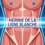 comment soigner une hernie de la ligne blanche sans operation image medicale ligne blanche